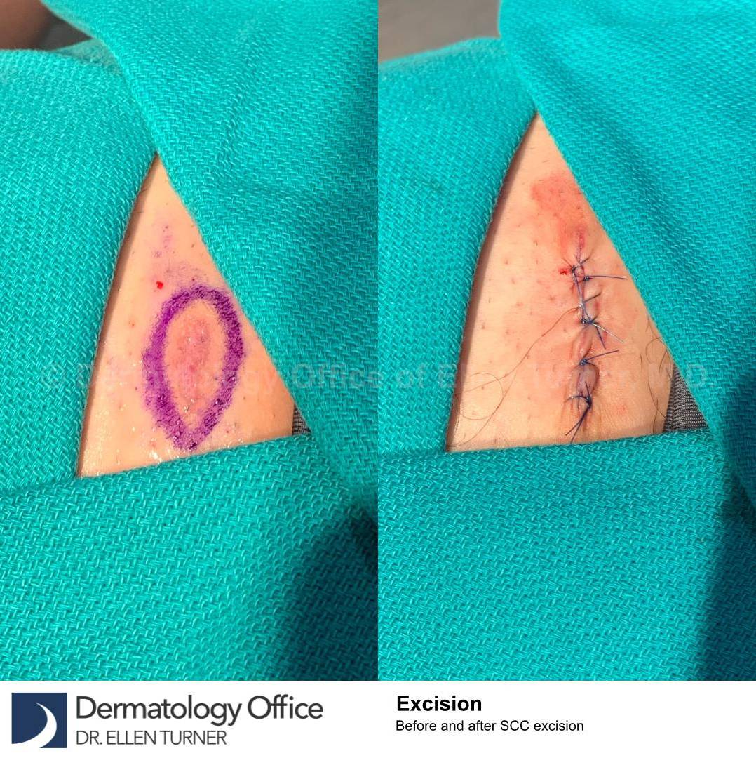 Skin Cancer (Excision) Case-105 