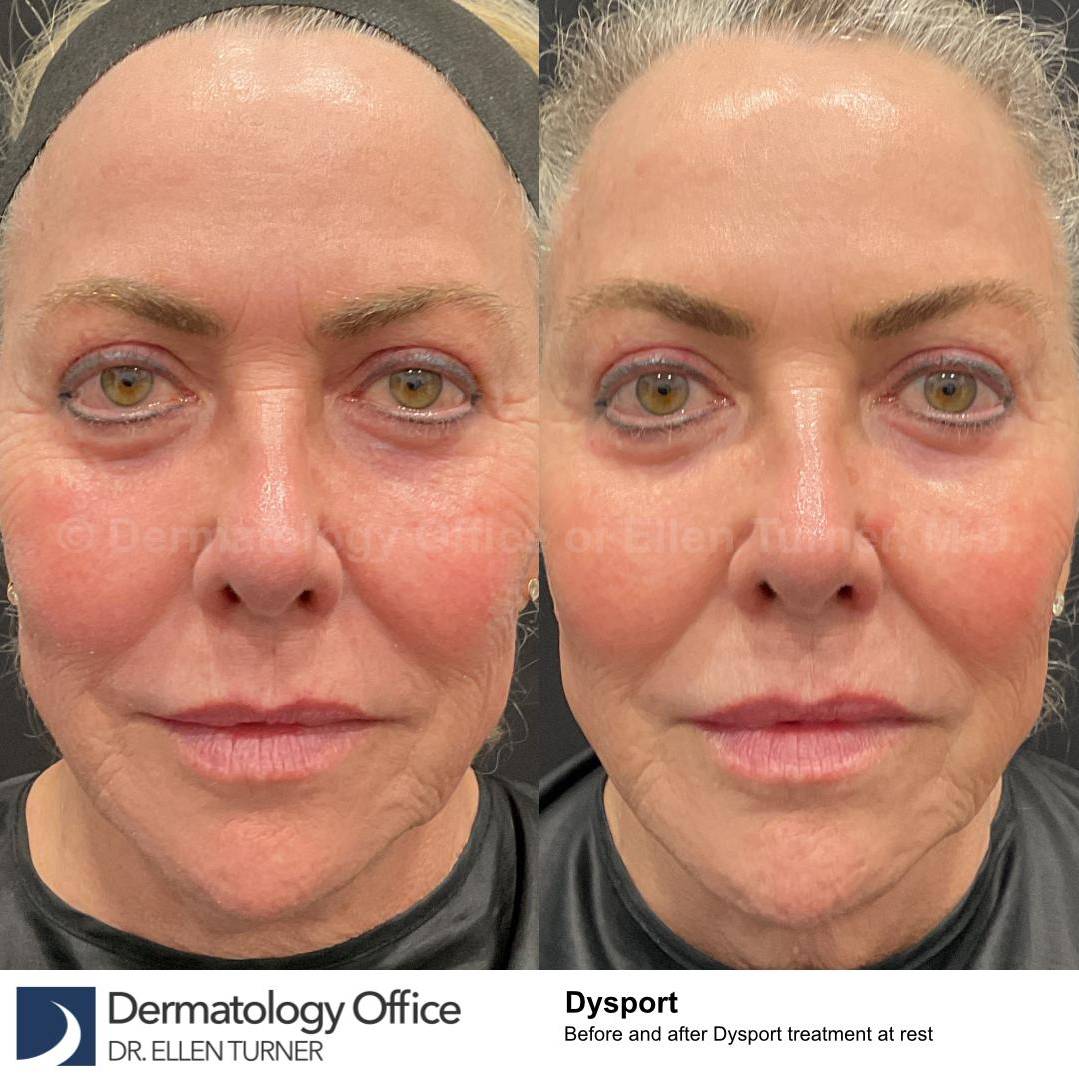 Dysport Before and after Case-8  Dysport Before and after Case-8