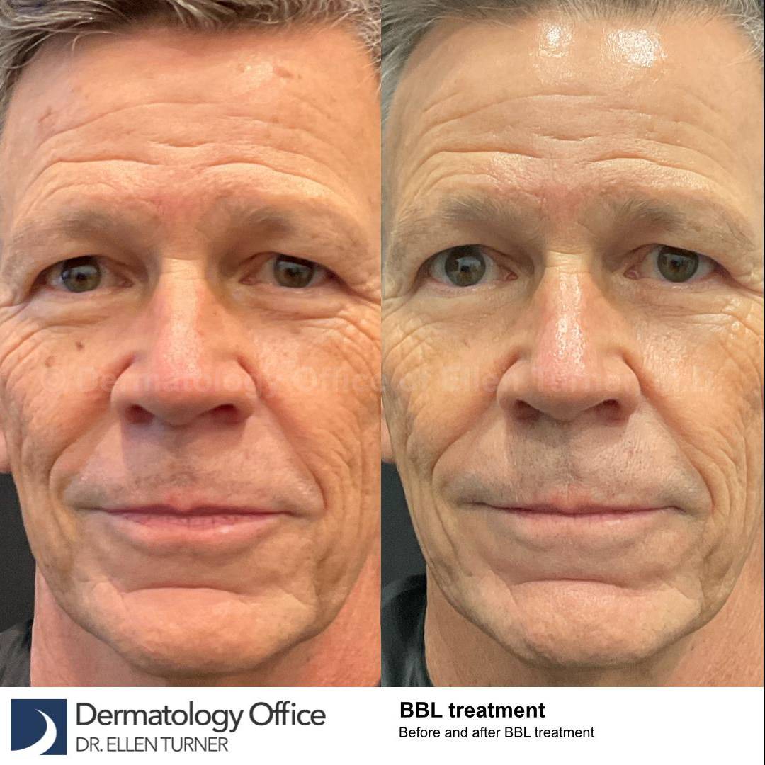 IPL-Photofacial/BBL BroadBand Laser Case-13  IPL-Photofacial/BBL BroadBand Laser Case-13