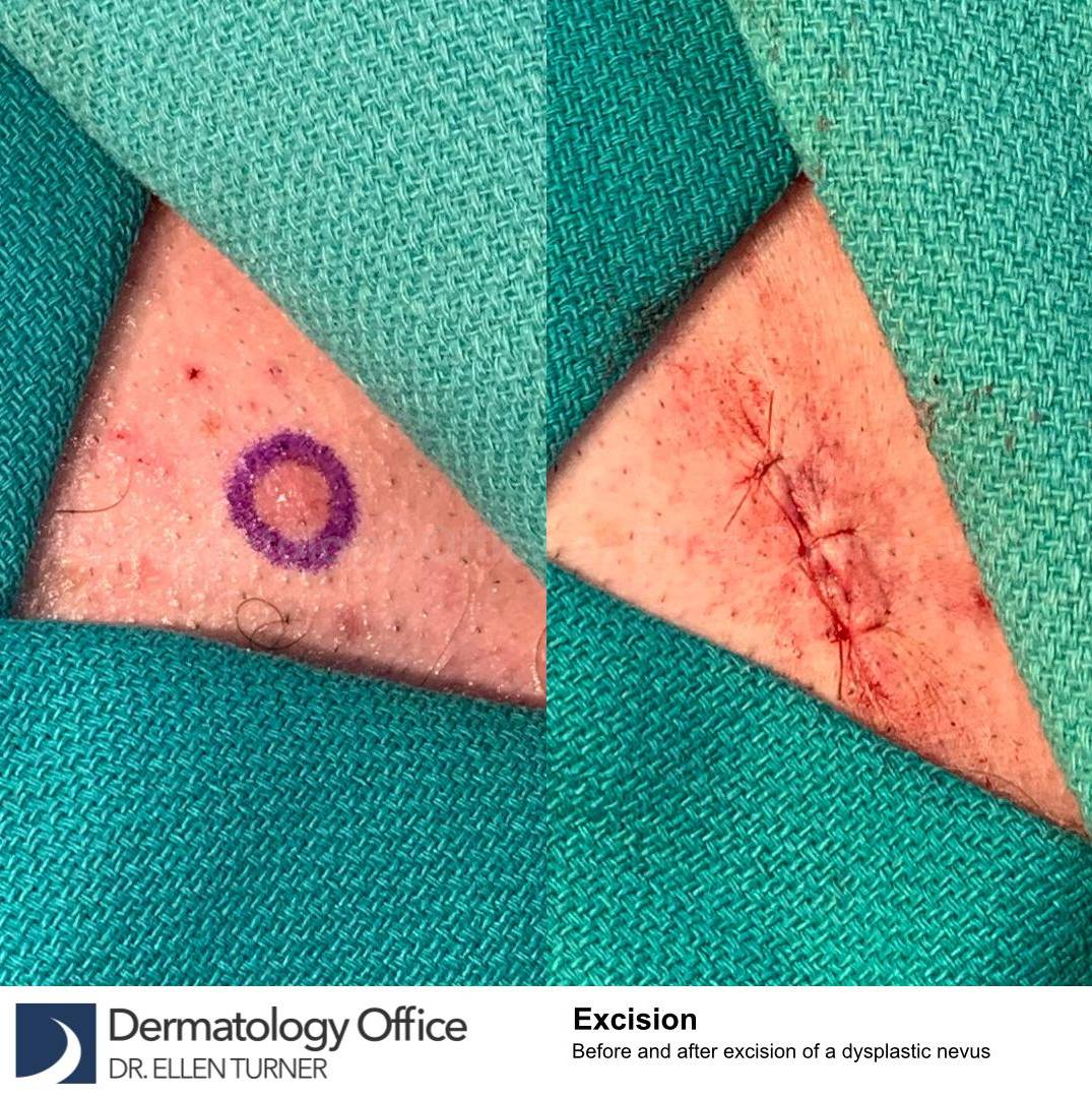 Cyst Removal Before and After Case-55  Cyst Removal Before and After Case-55