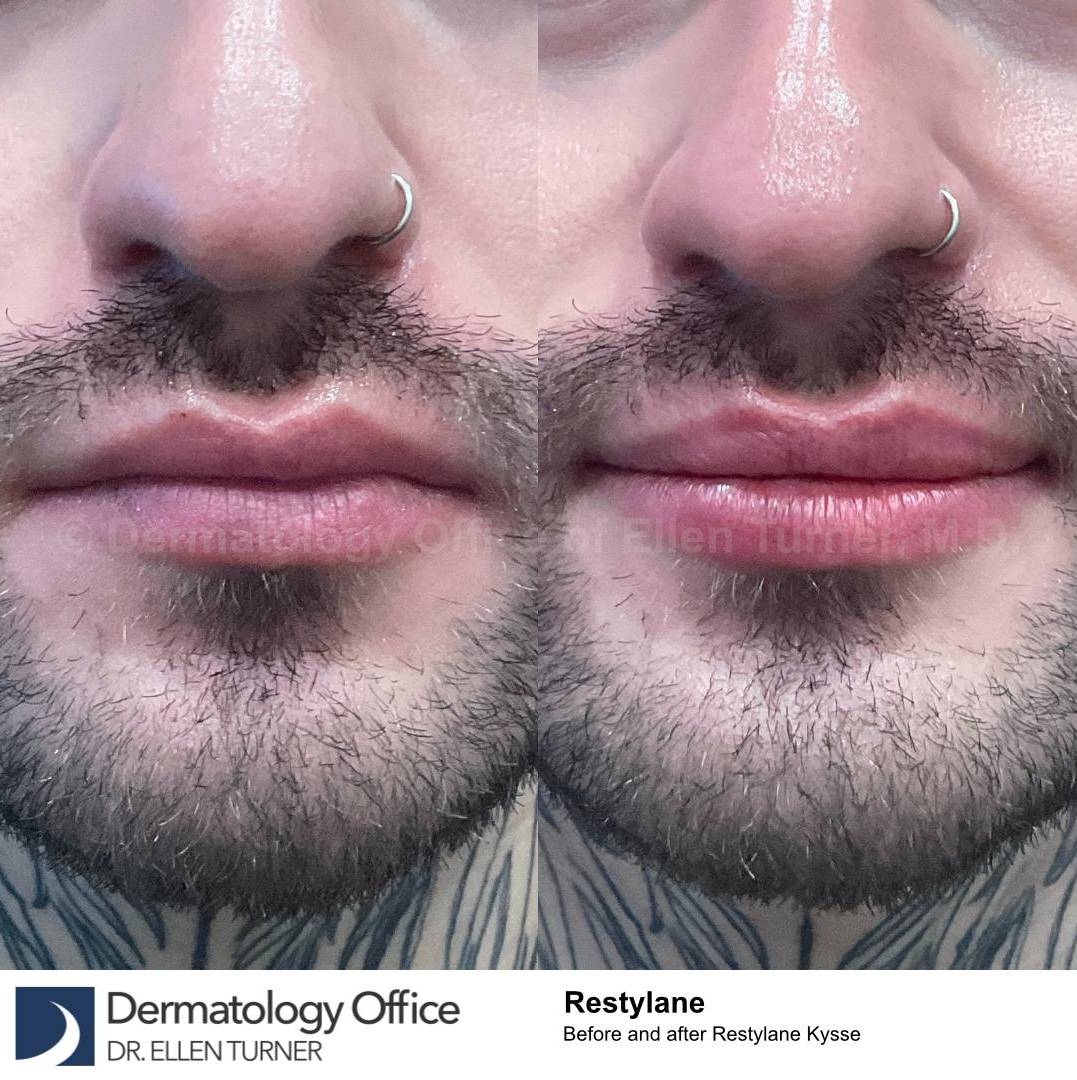 Restylane Before and After Case 33  Restylane Before and After Case 33