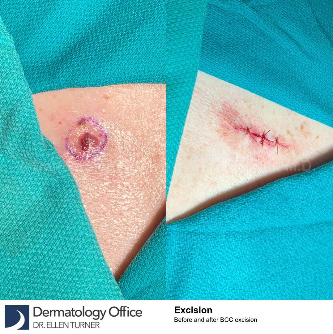 Skin Cancer (Excision) Case-108  Skin Cancer (Excision) Case-108