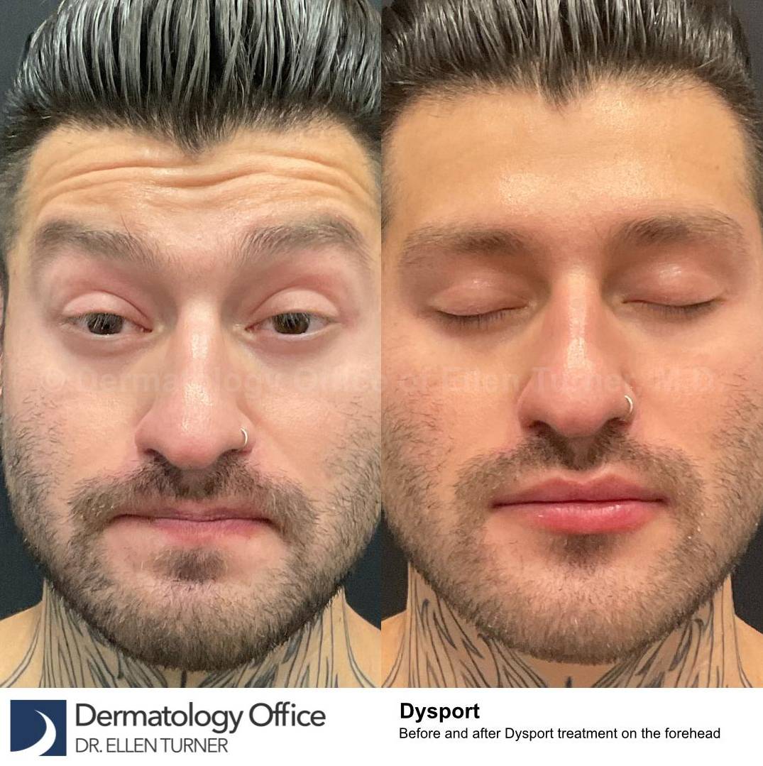 Dysport Before and after Case-9  Dysport Before and after Case-9