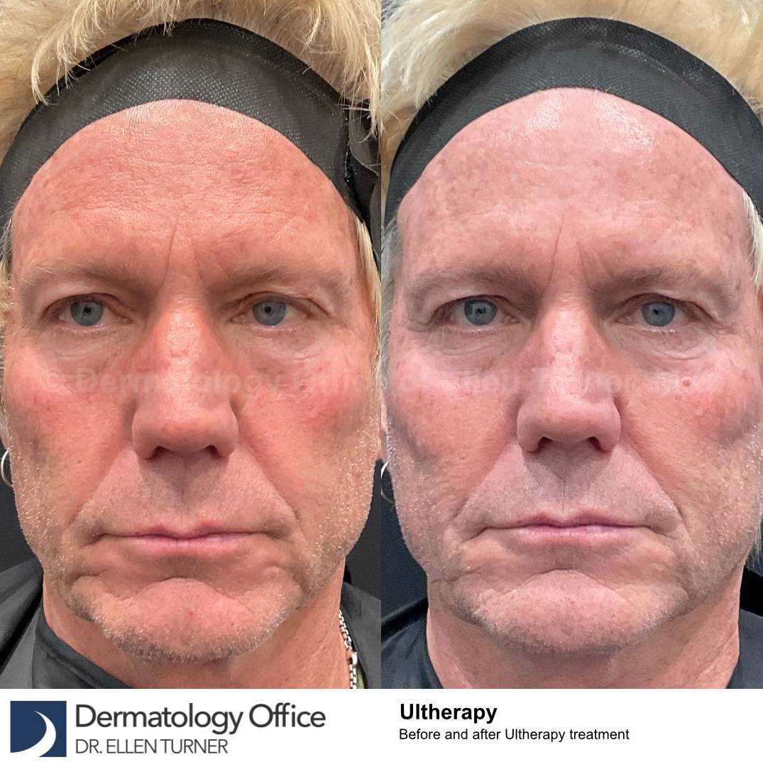 Ultherapy Before and After Case 10  Ultherapy Before and After Case 10