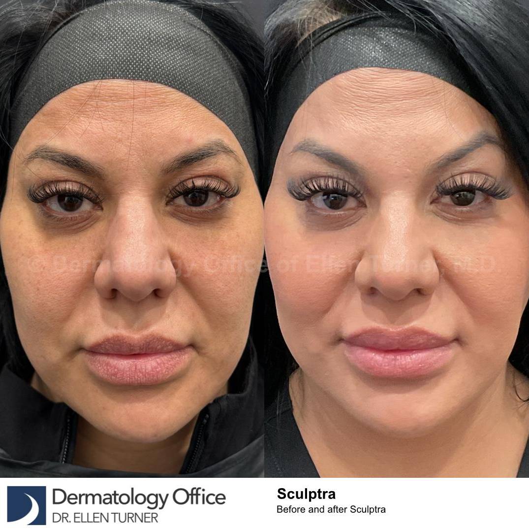 Sculptra Before and After Case 8  Sculptra Before and After Case 8