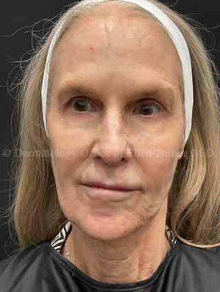 Ultherapy Before and After Case 11 Before