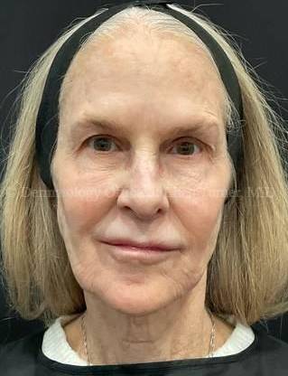 Ultherapy Before and After Case 11 After