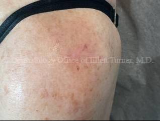 SRT-100 Before and After Case-89 After