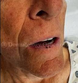 SRT-100 Before and After Case-90 Before