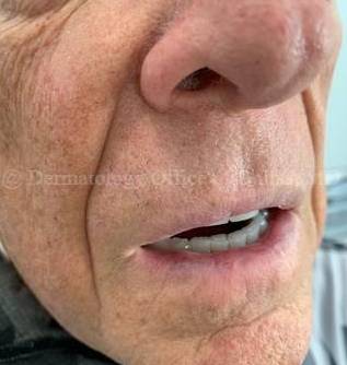 SRT-100 Before and After Case-90 After