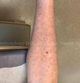 SRT-100 Before and After Case-88 Before