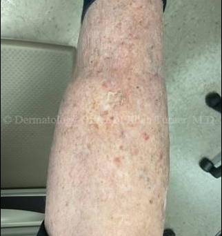 SRT-100 Before and After Case-88 After