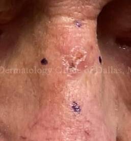 SRT-100 Before and After Case-91 Before