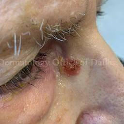 SRT-100 Before and After Case-92 Before