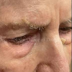 SRT-100 Before and After Case-92 After