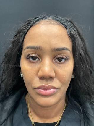 Dysport Before and after Case-7 After