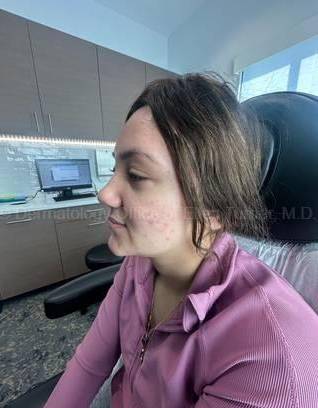 Acne Before and After Case -28 Before