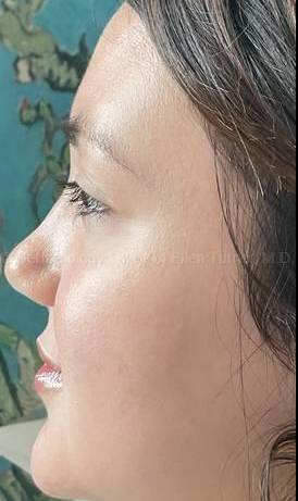 Acne Before and After Case -28 After