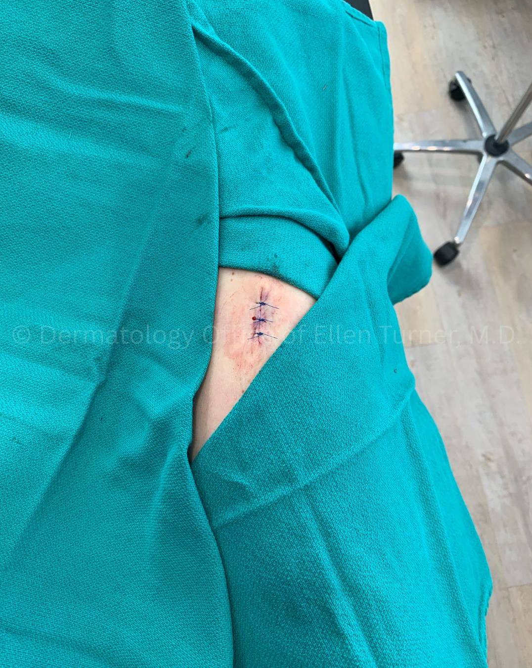 Moles (Excision) Case-2 After