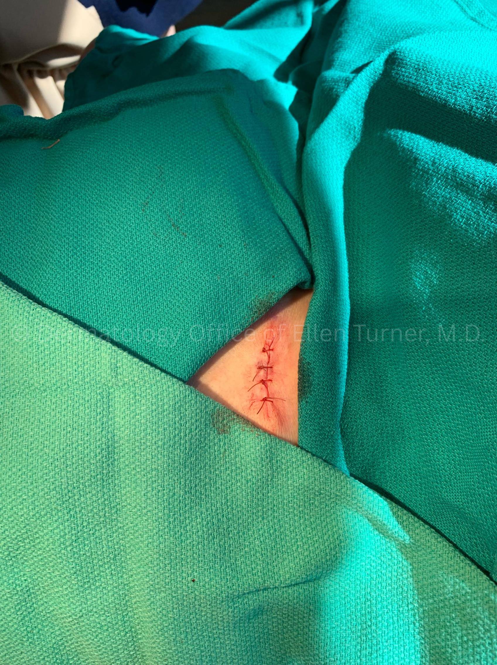 Cyst Removal Case-57 After