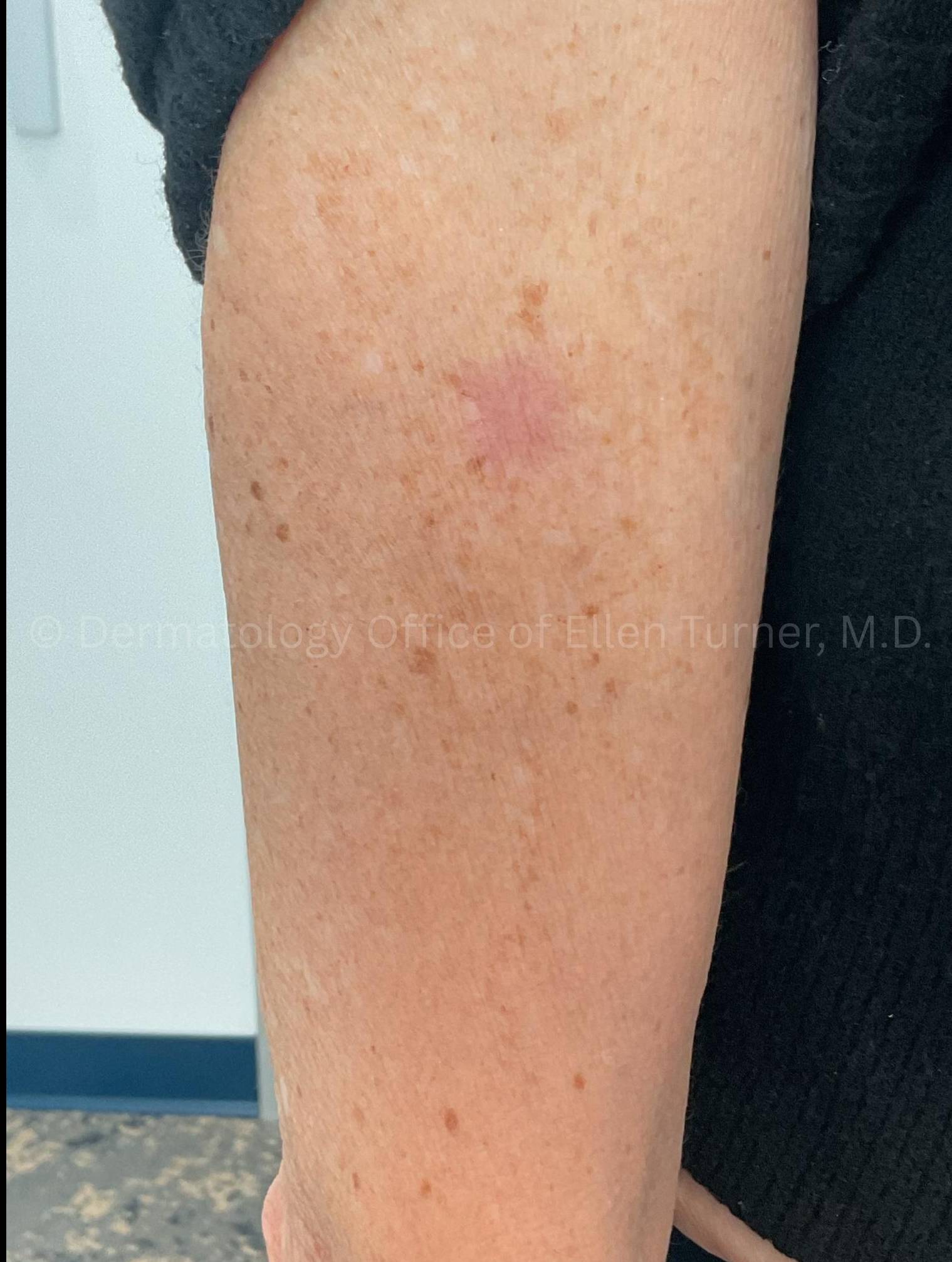 SRT-100 Before and After Case-93 After