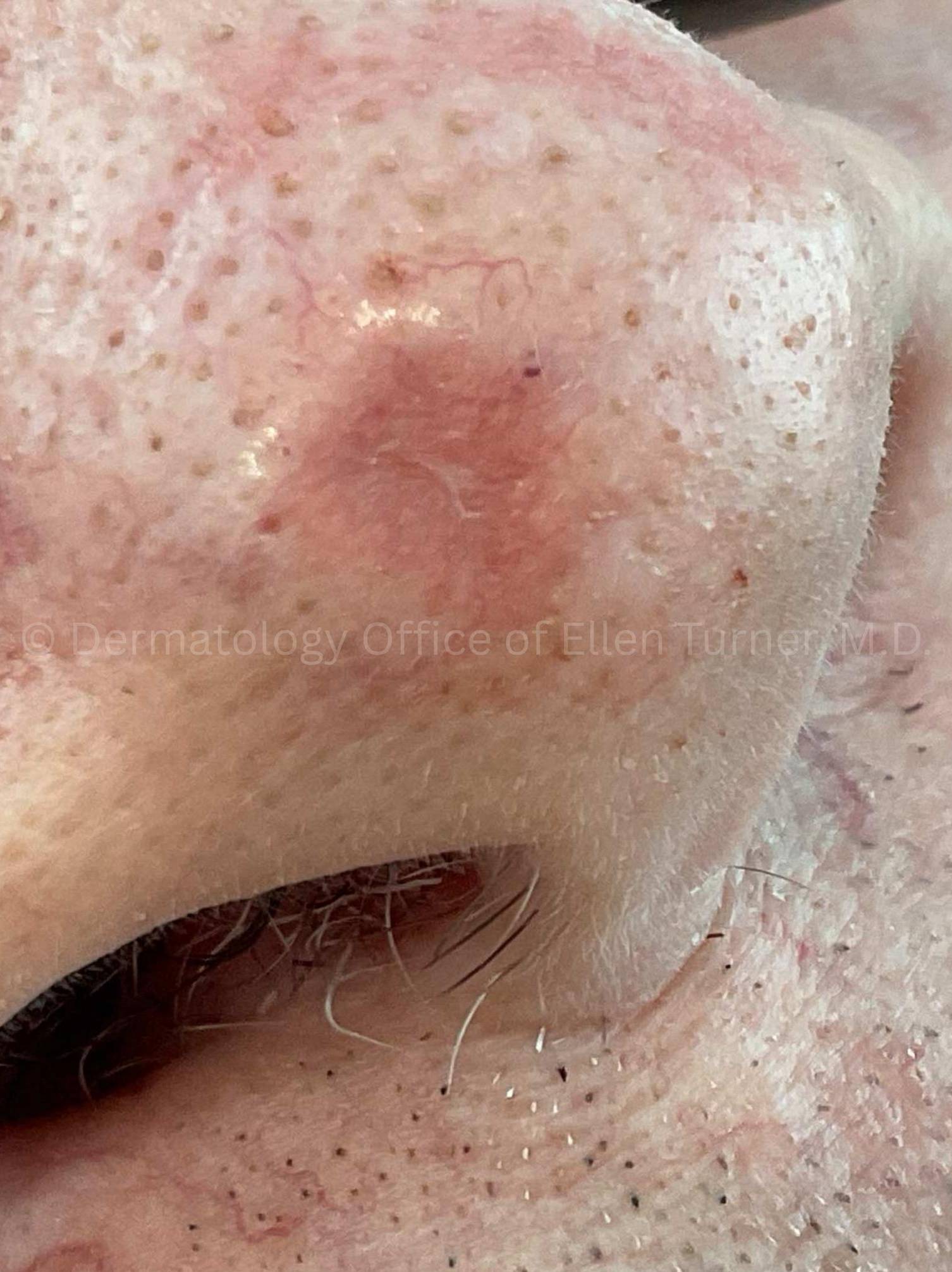 SRT-100 Before and After Case-94 Before