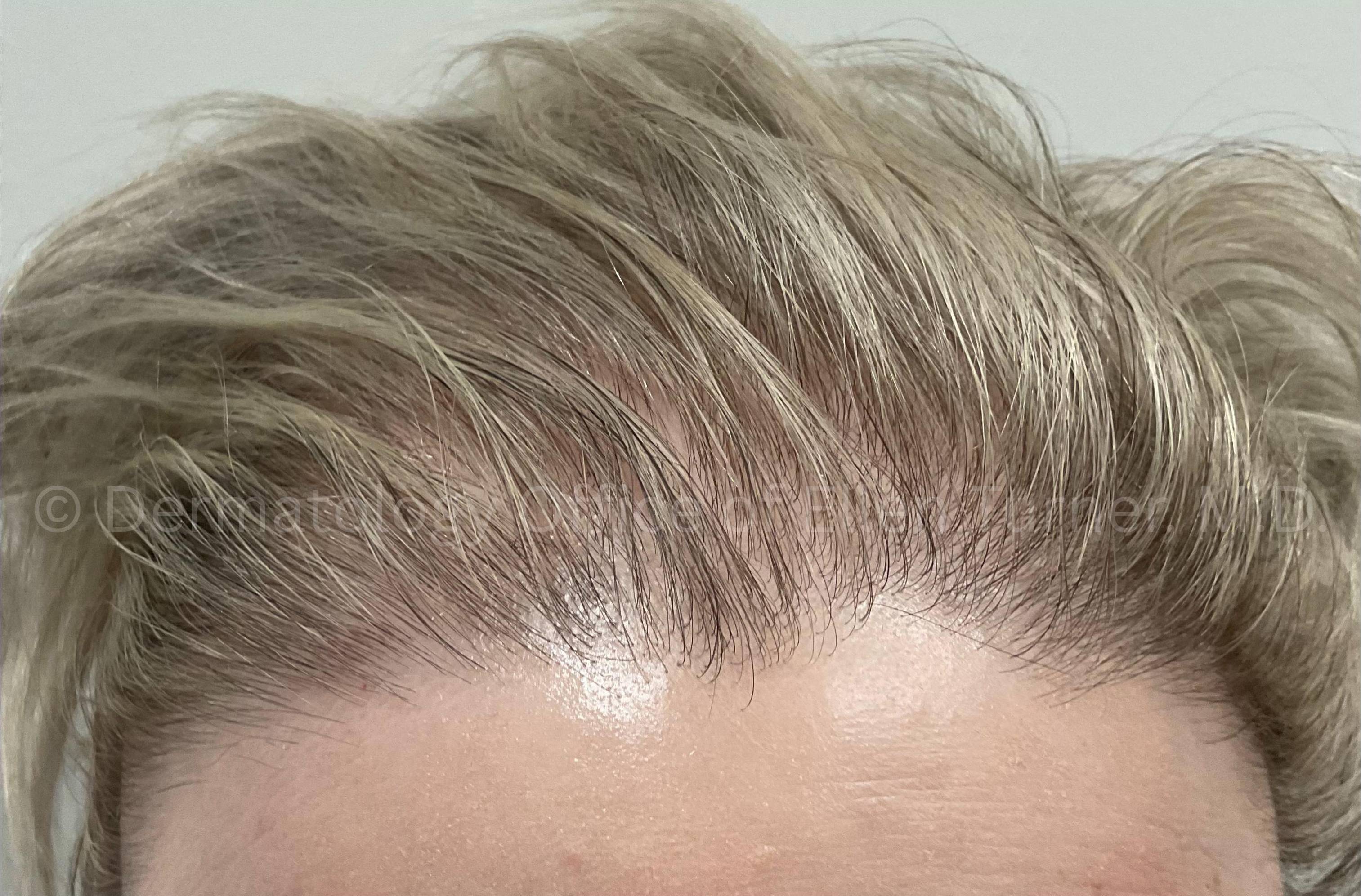 Hair Loss Before and After Case-17 After