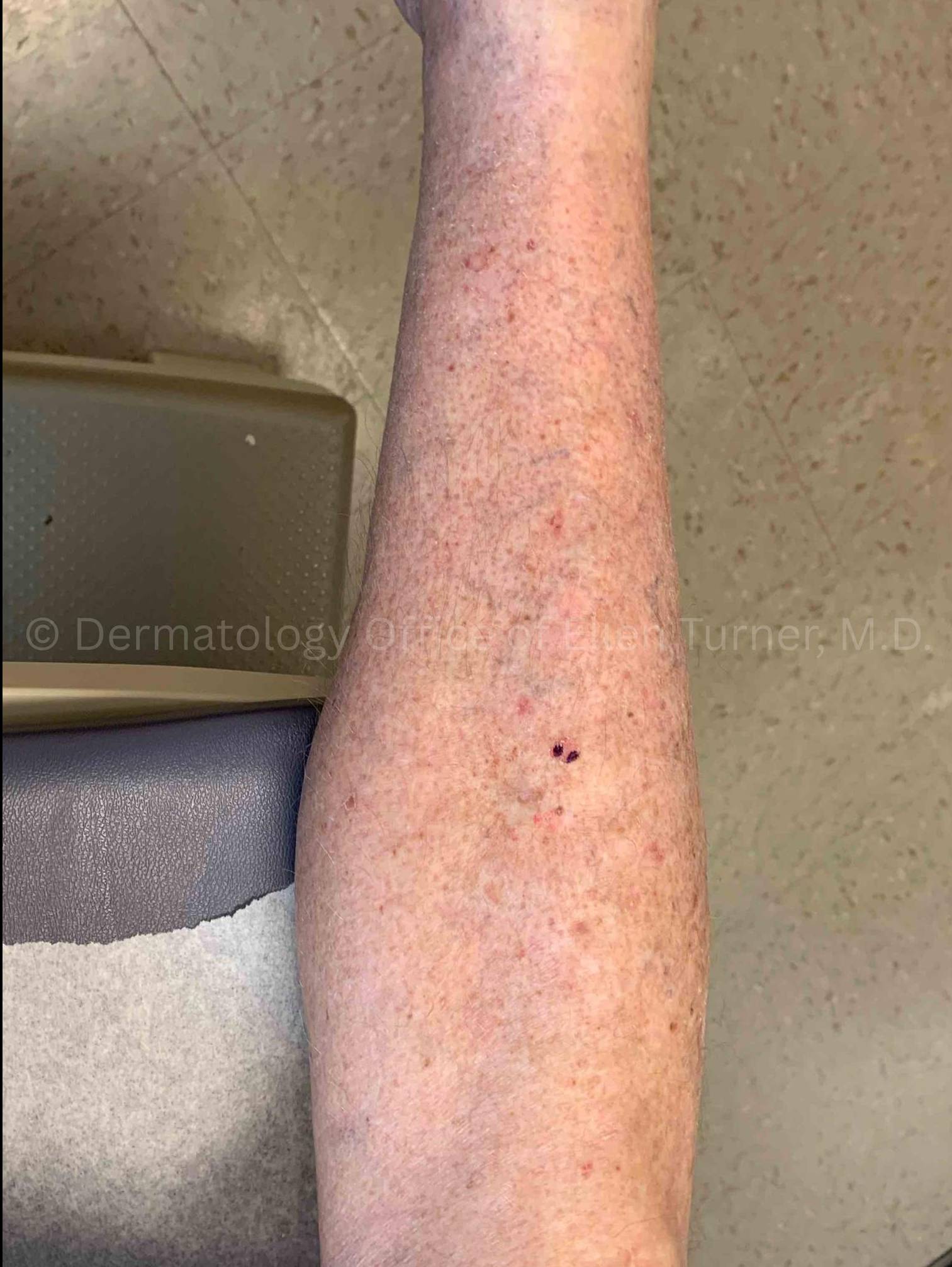 SRT-100 Before and After Case-88 Before