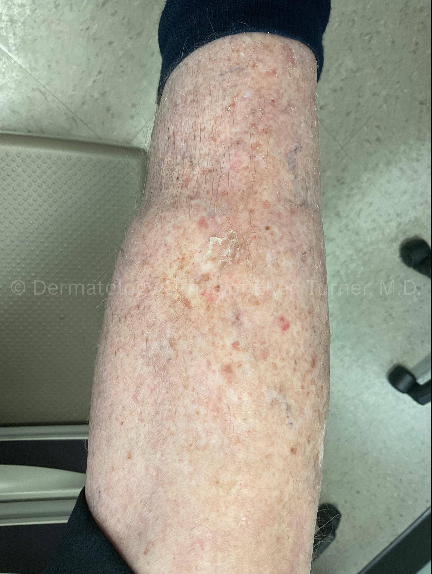 SRT-100 Before and After Case-88 After