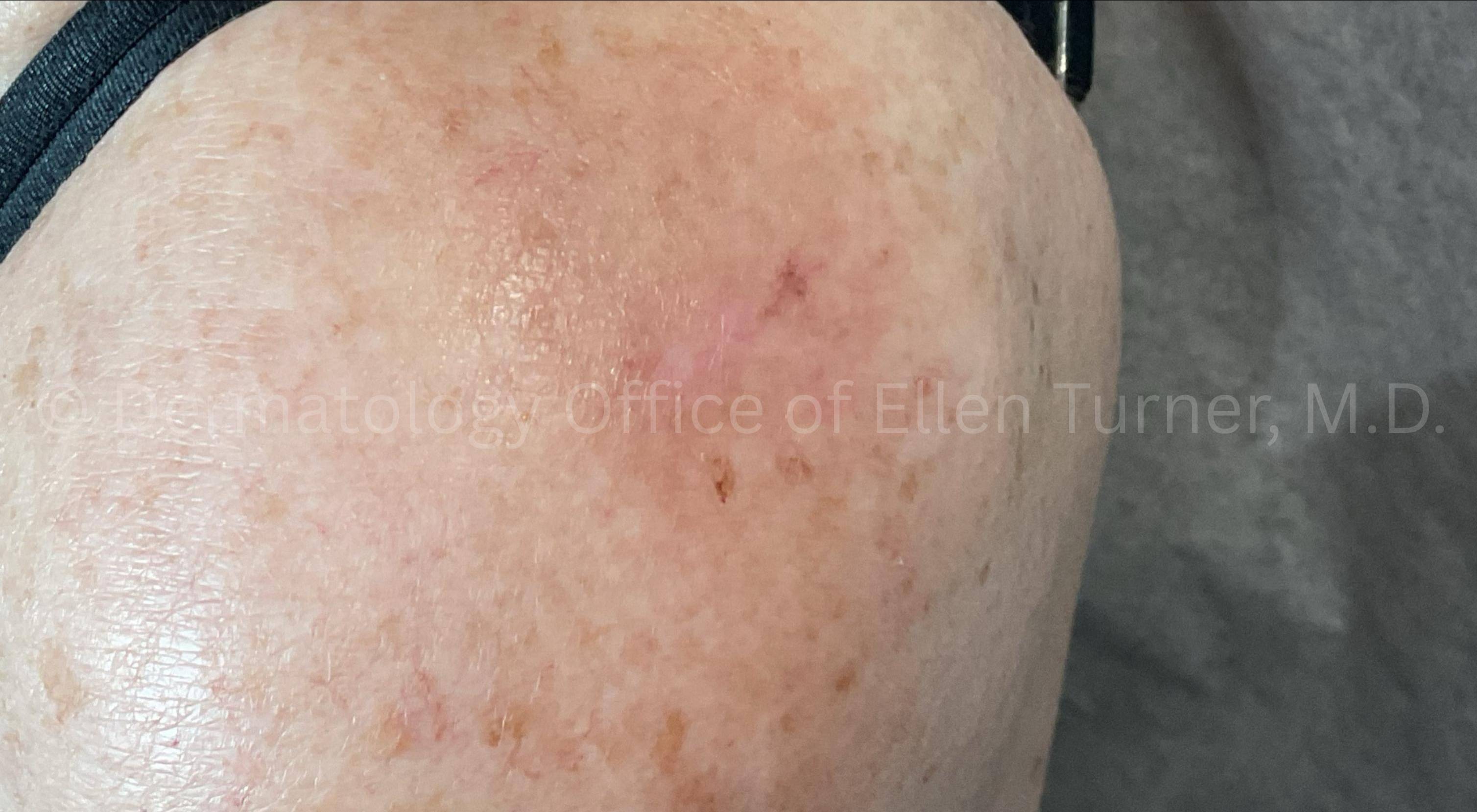 SRT-100 Before and After Case-89 After