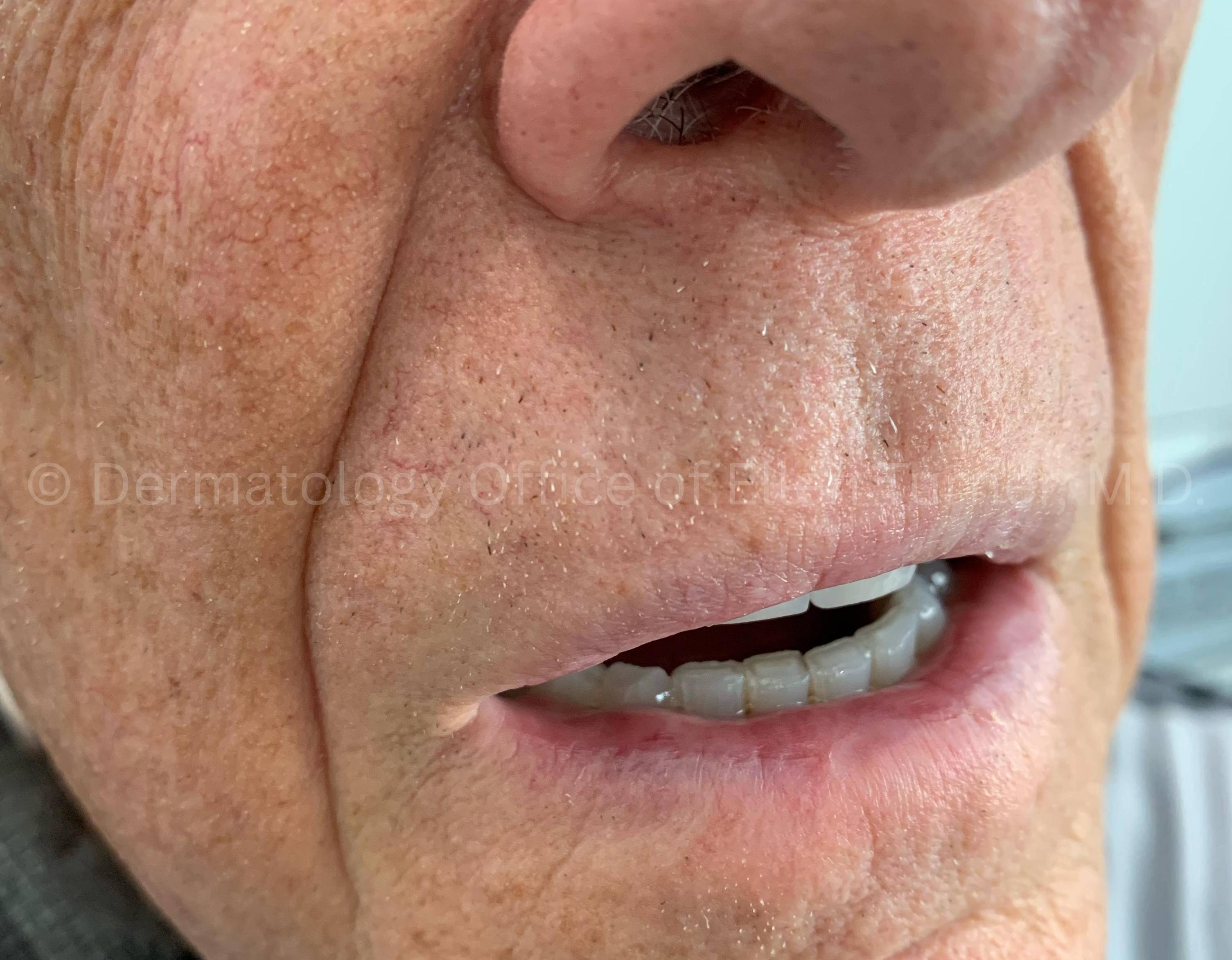 SRT-100 Before and After Case-90 After