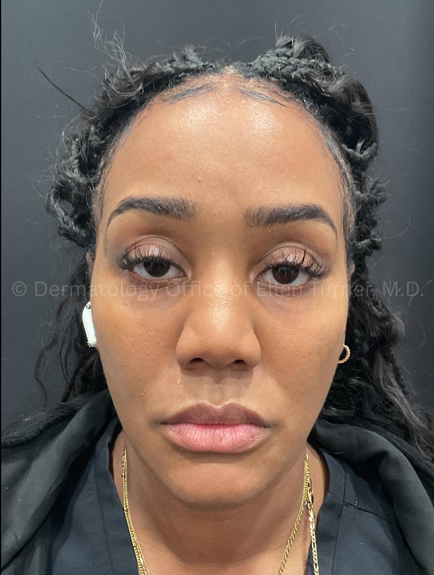 Dysport Before and after Case-7 Before