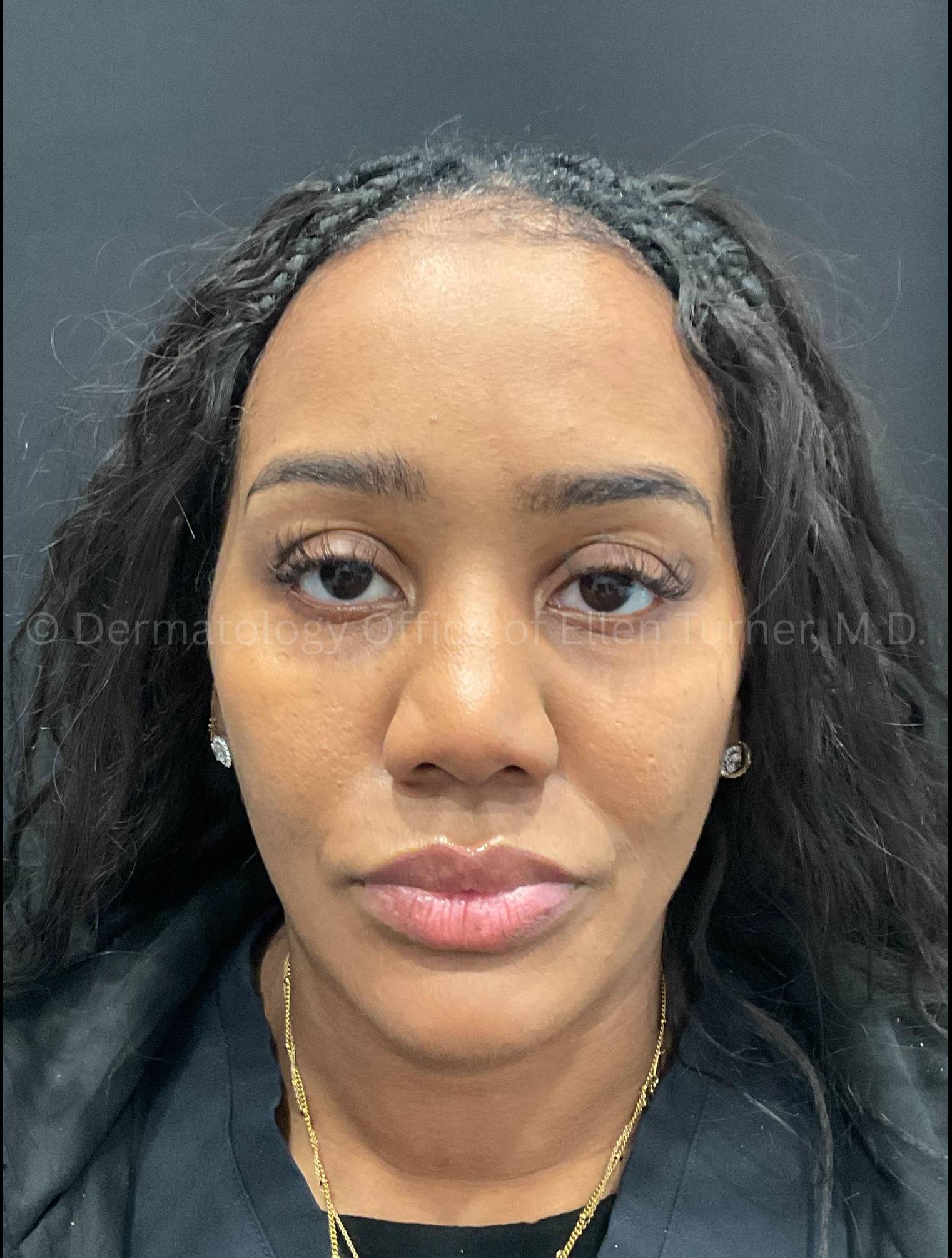 Dysport Before and after Case-7 After