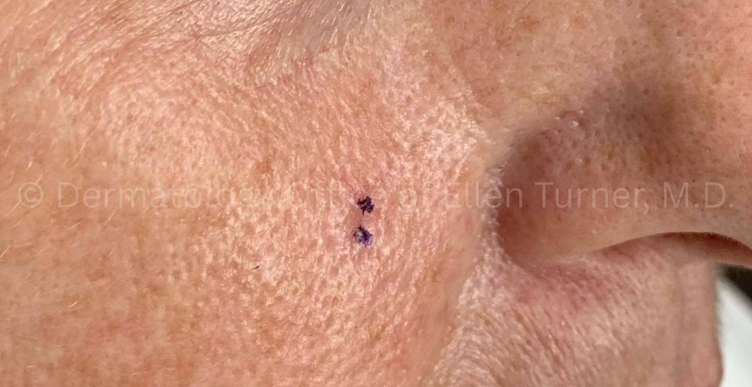 SRT-100 Before and After Case-95 Before