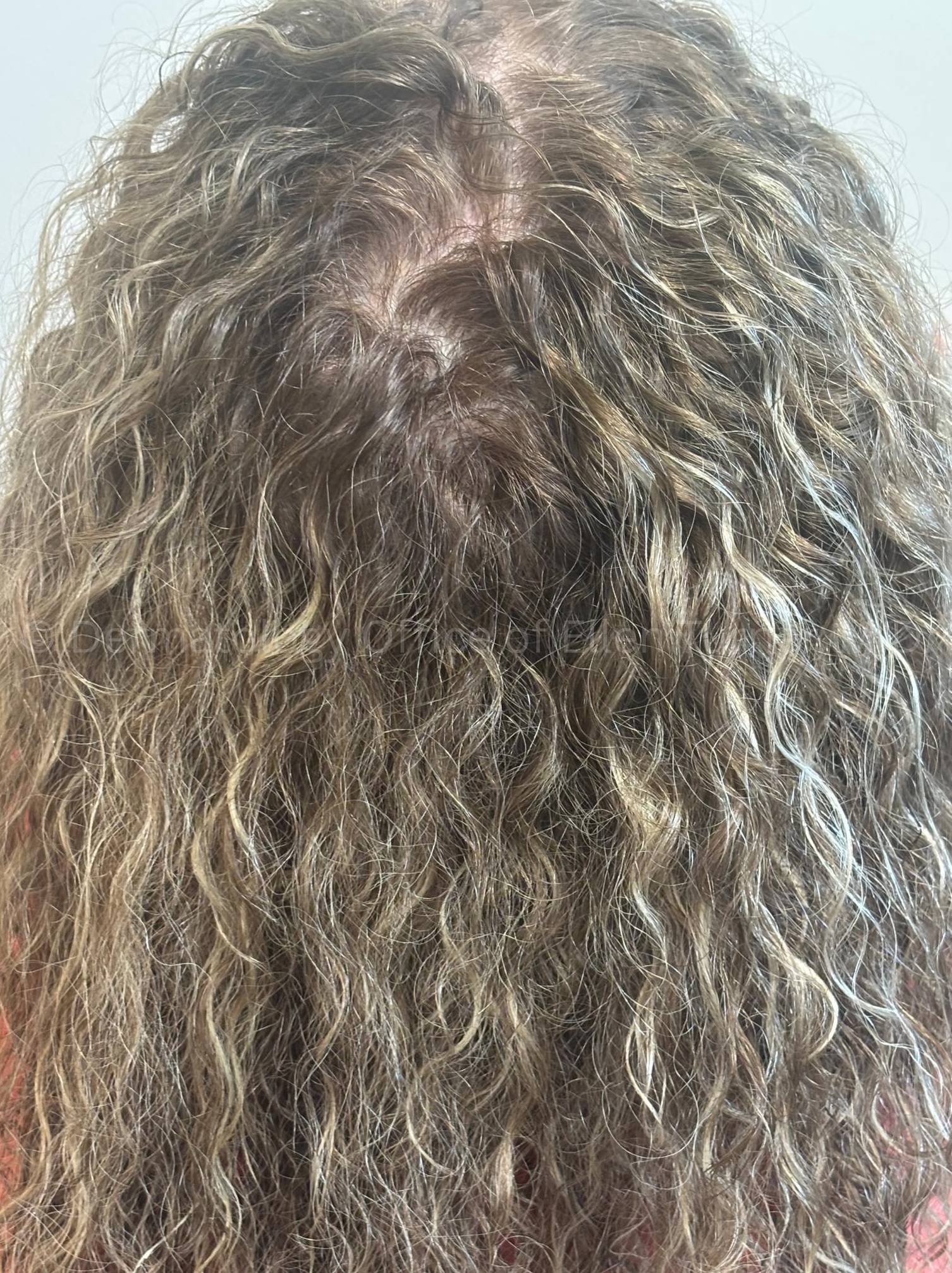 Hair Loss Before and After Case-18 After