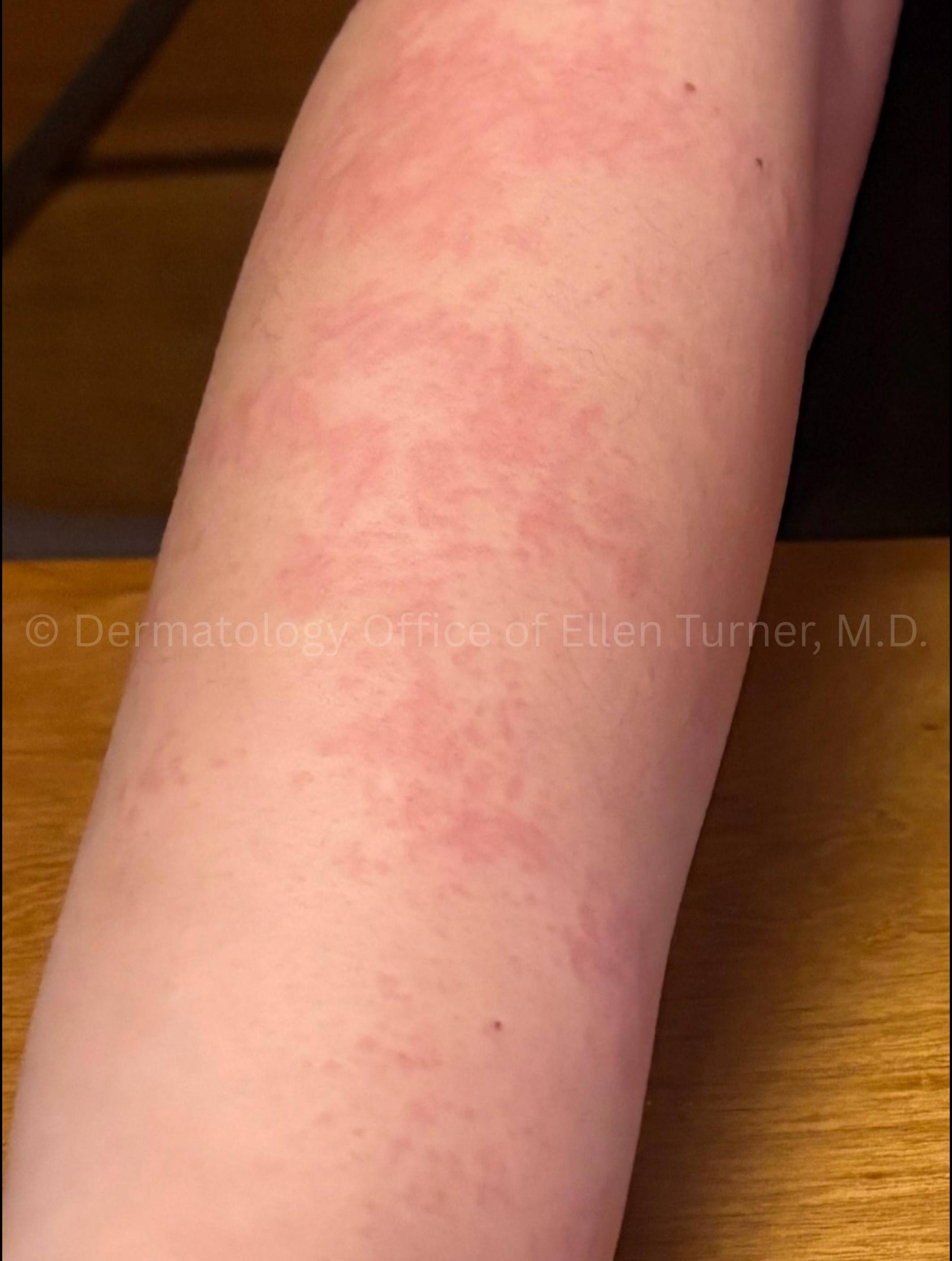 Rash Before and After Case - 1 Before