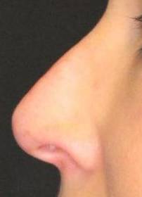 Voluma (1 Syringe) Case-6 After