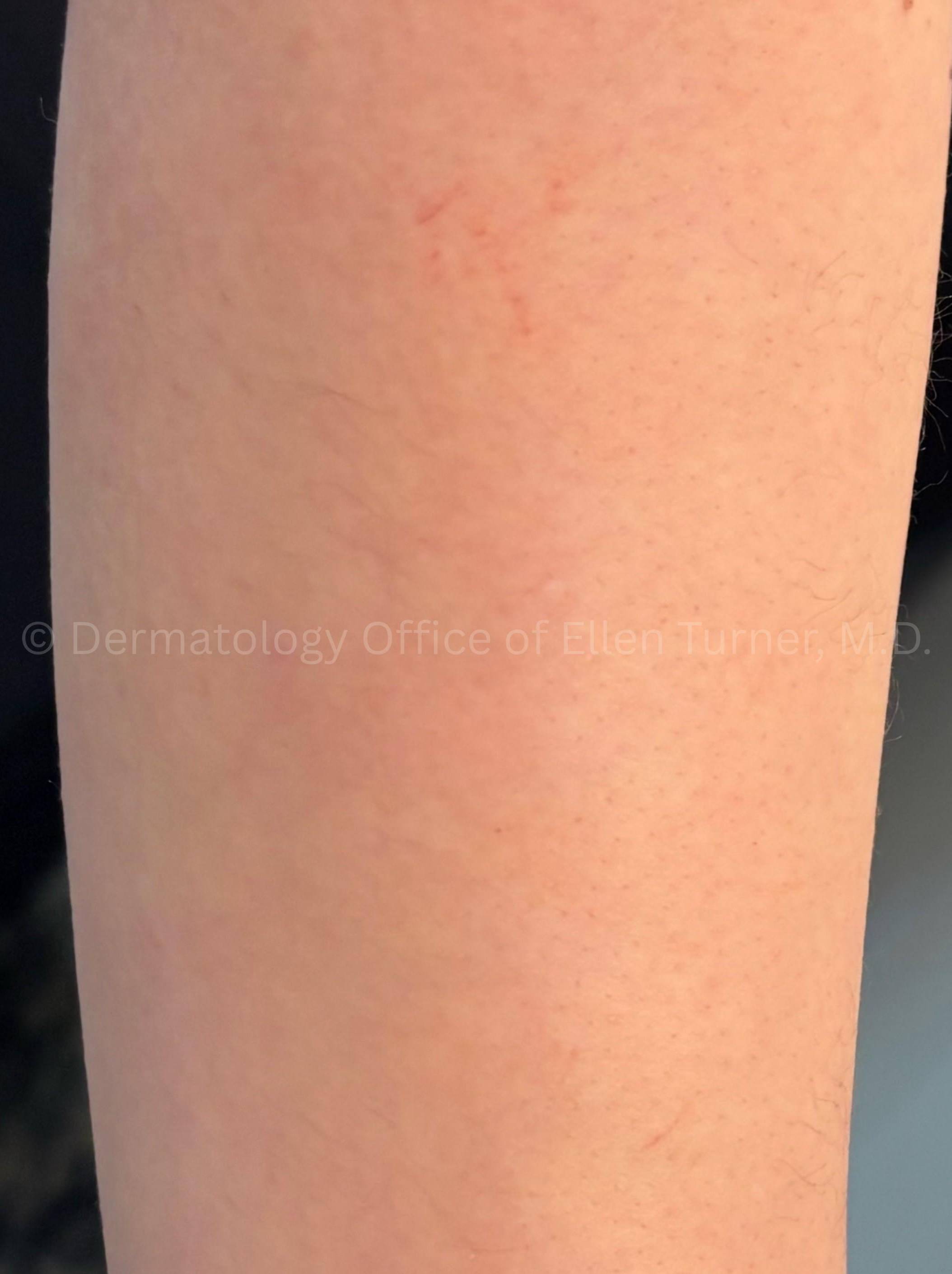 Rash Before and After Case - 1 After