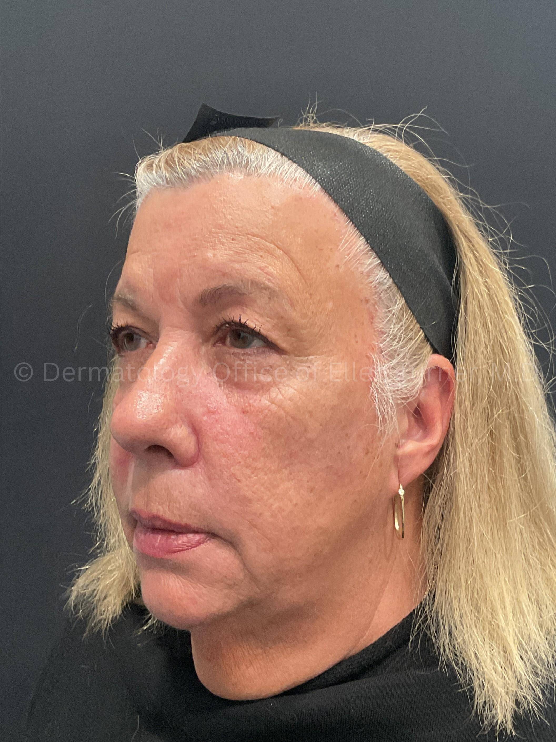 Restylane Before and After Case 34 After