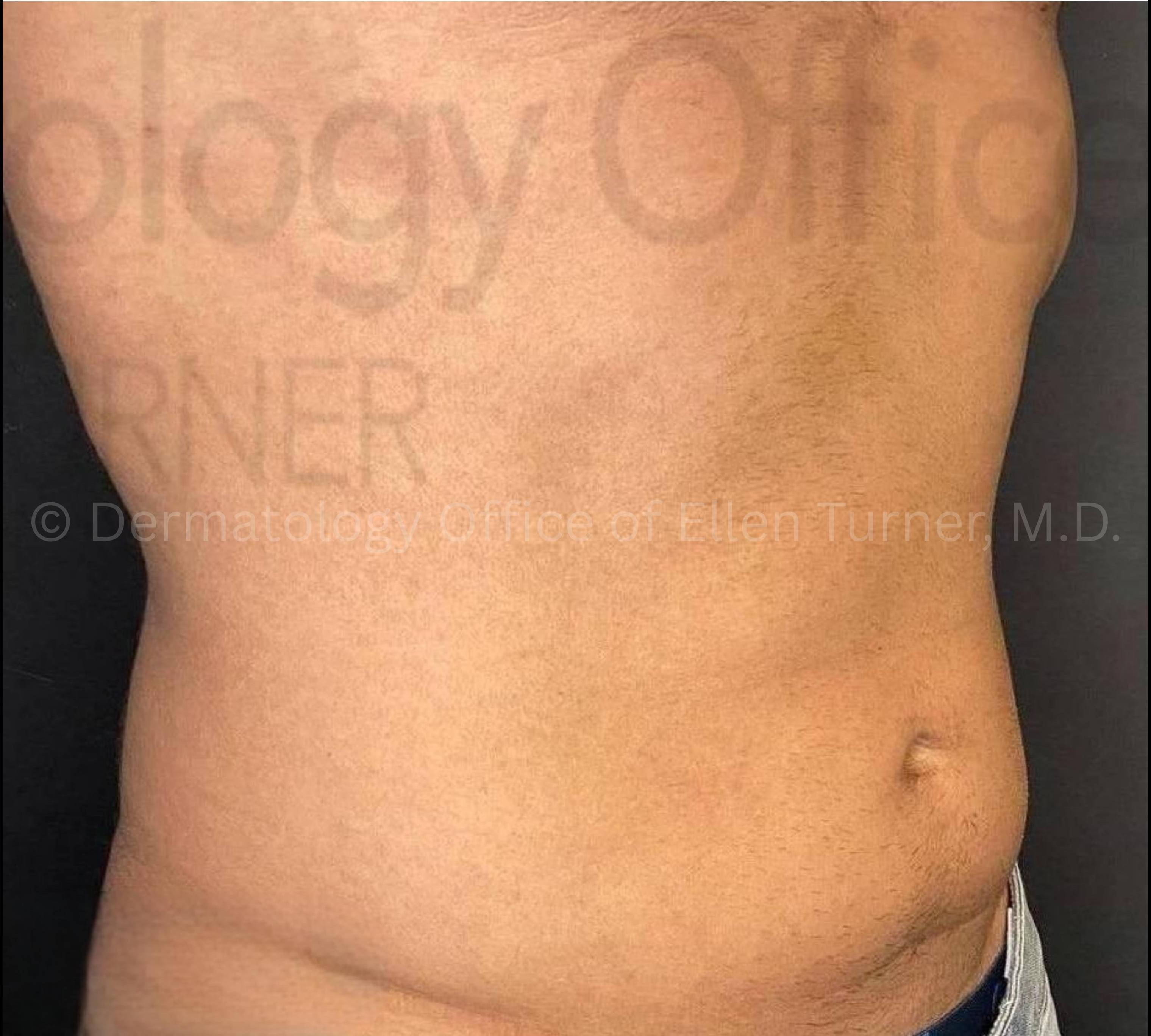 Bellafill (10 Syringes) Case 1 After