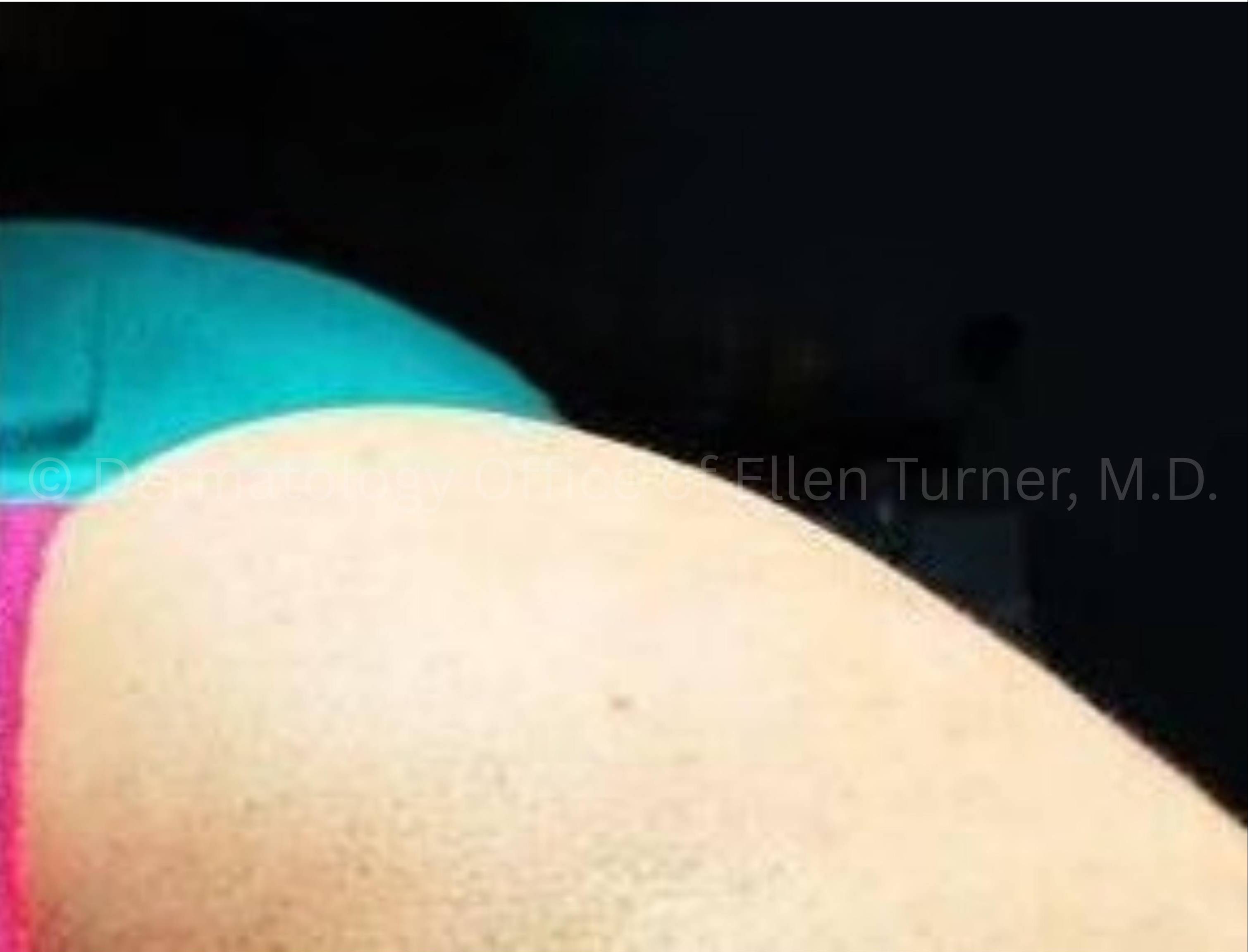 Sculptra (10 Vials) Before and After Case 1 After