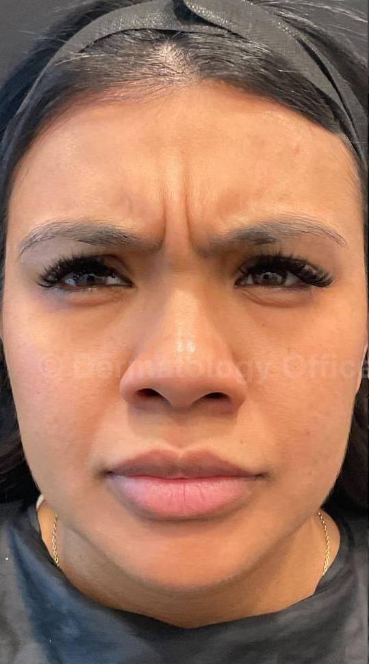 Dysport Before and after Case-3 Before