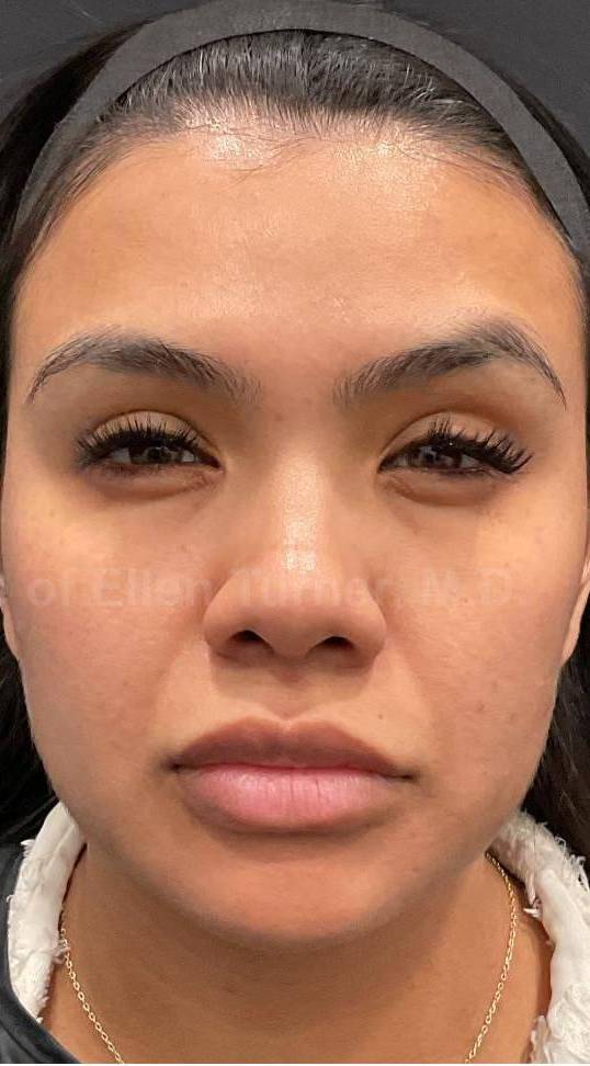 Dysport Before and after Case-3 After