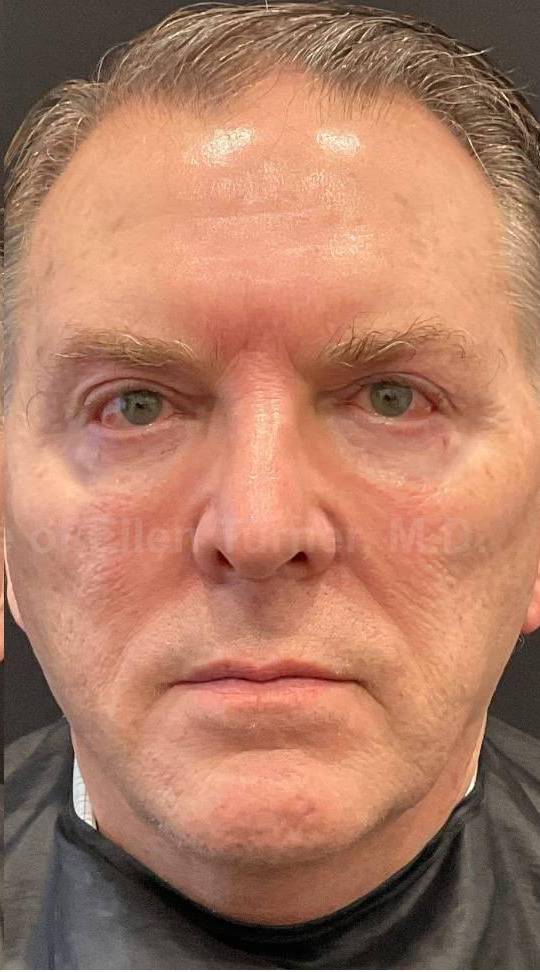 Dysport Before and after Case-4 After