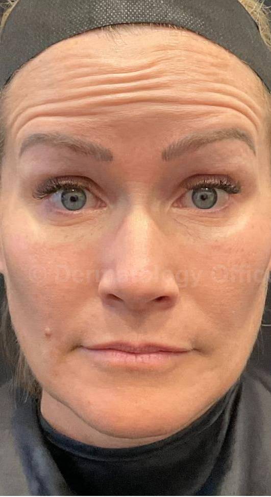 Dysport Before and after Case-5 Before