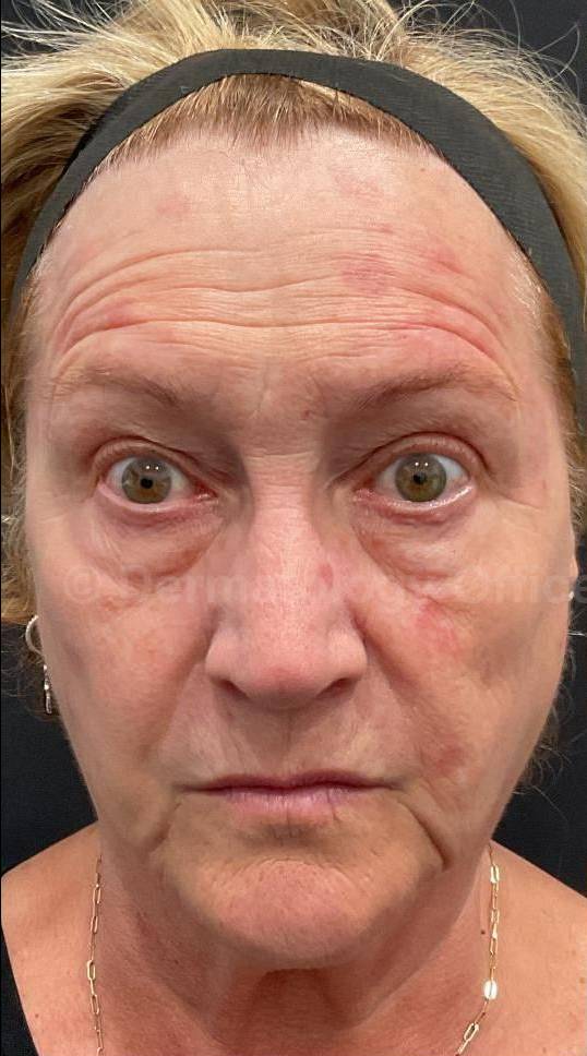 Dysport Before and after Case-6 Before