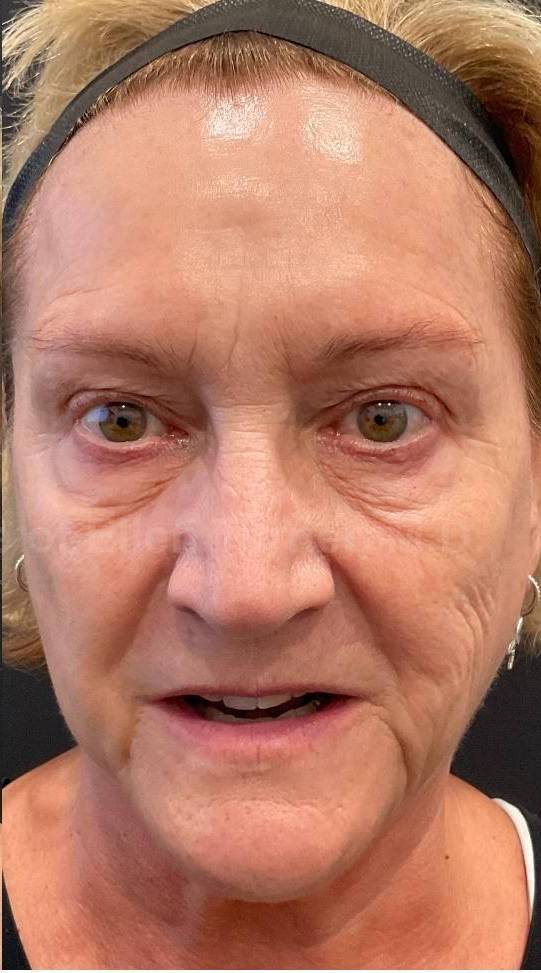 Dysport Before and after Case-6 After