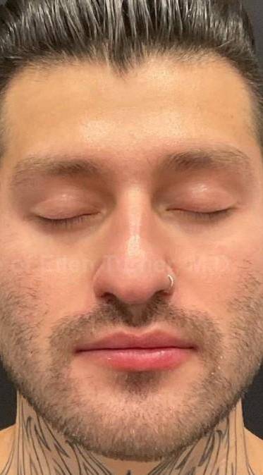 Dysport Before and after Case-9 After