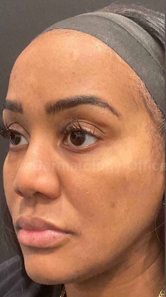 Platelet-Rich Plasma Before and After Case 1 Before