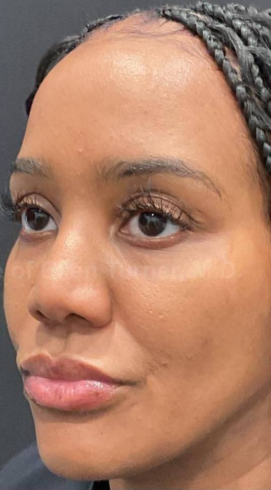 Platelet-Rich Plasma Before and After Case 1 After